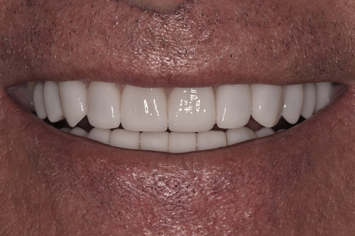 Before After Dental Photos Before and After | BayView Dental Arts