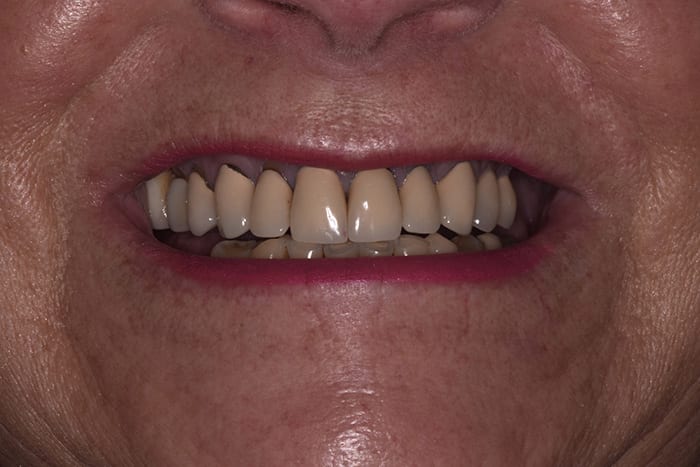 Before After Dental Photos Before and After | BayView Dental Arts