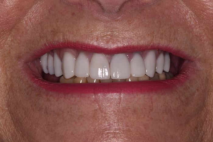 Before After Dental Photos Before and After | BayView Dental Arts