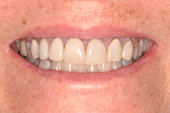 Before After Dental Photos Before and After | BayView Dental Arts