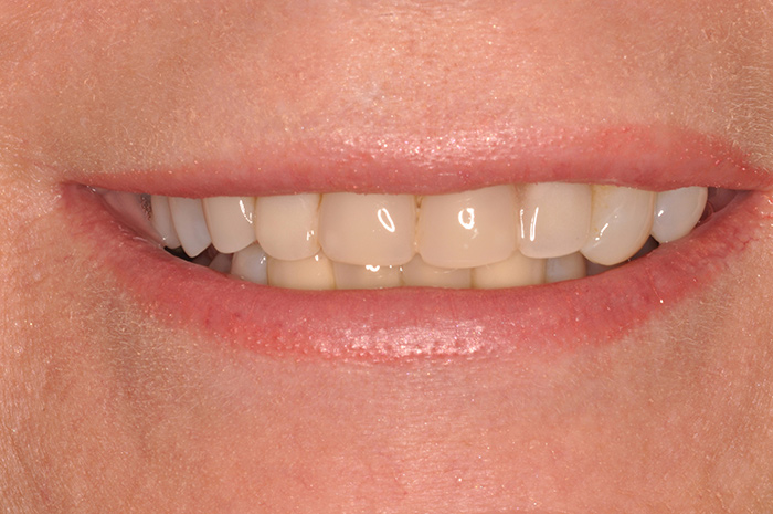 Before After Dental Photos Before and After | BayView Dental Arts