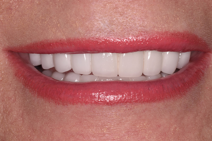 Before After Dental Photos Before and After | BayView Dental Arts