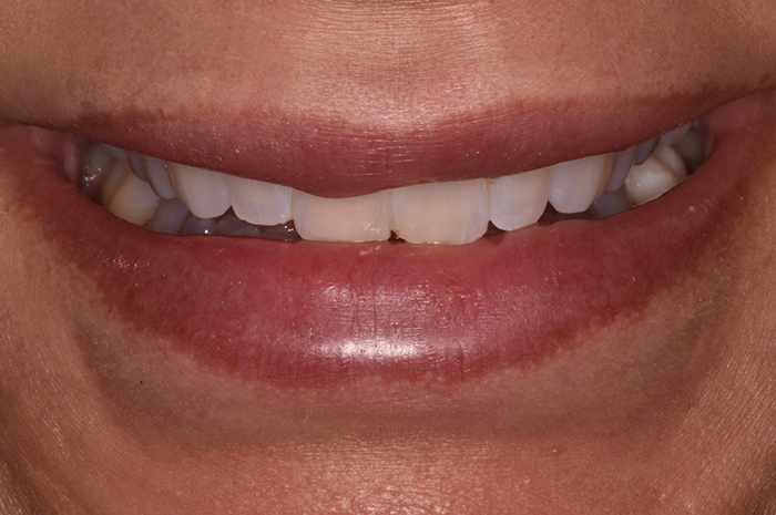 Before After Dental Photos Before and After | BayView Dental Arts