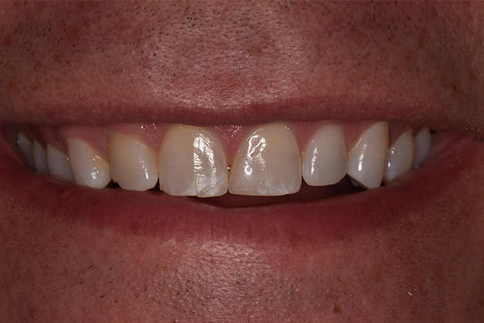 Before After Dental Photos Before and After | BayView Dental Arts