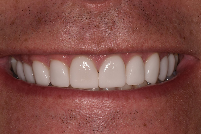 Before After Dental Photos Before and After | BayView Dental Arts