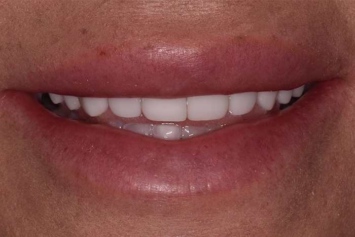 Before After Dental Photos Before and After | BayView Dental Arts