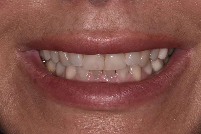 Before After Dental Photos Before and After | BayView Dental Arts