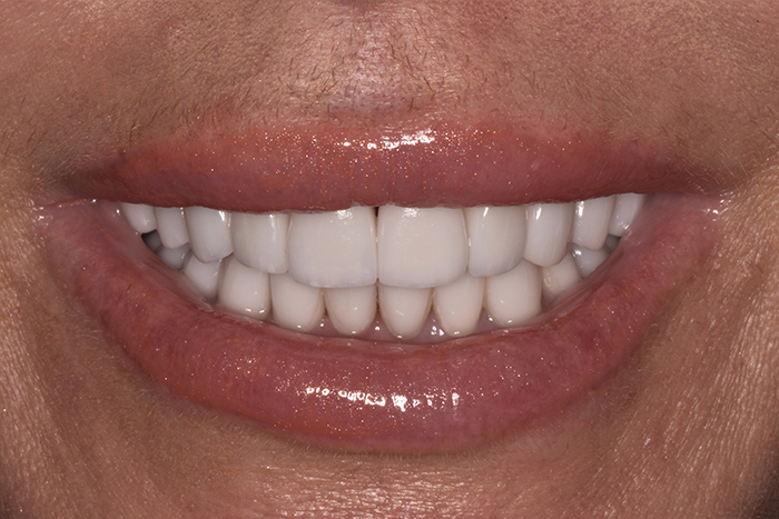 Before After Dental Photos Before and After | BayView Dental Arts