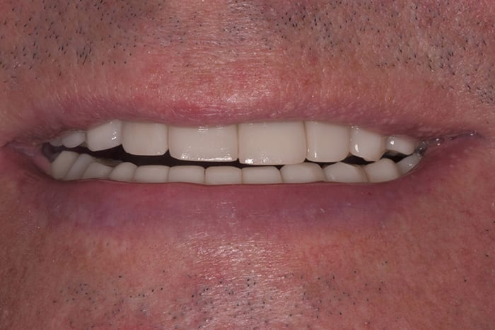 Before After Dental Photos Before and After | BayView Dental Arts